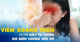 Viêm xoang trán: từ A - Z triệu chứng, nguyên nhân & cách điều trị